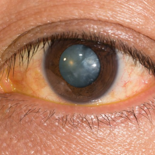 sharpvisioneyehospital best-cataract-treatment-near-me